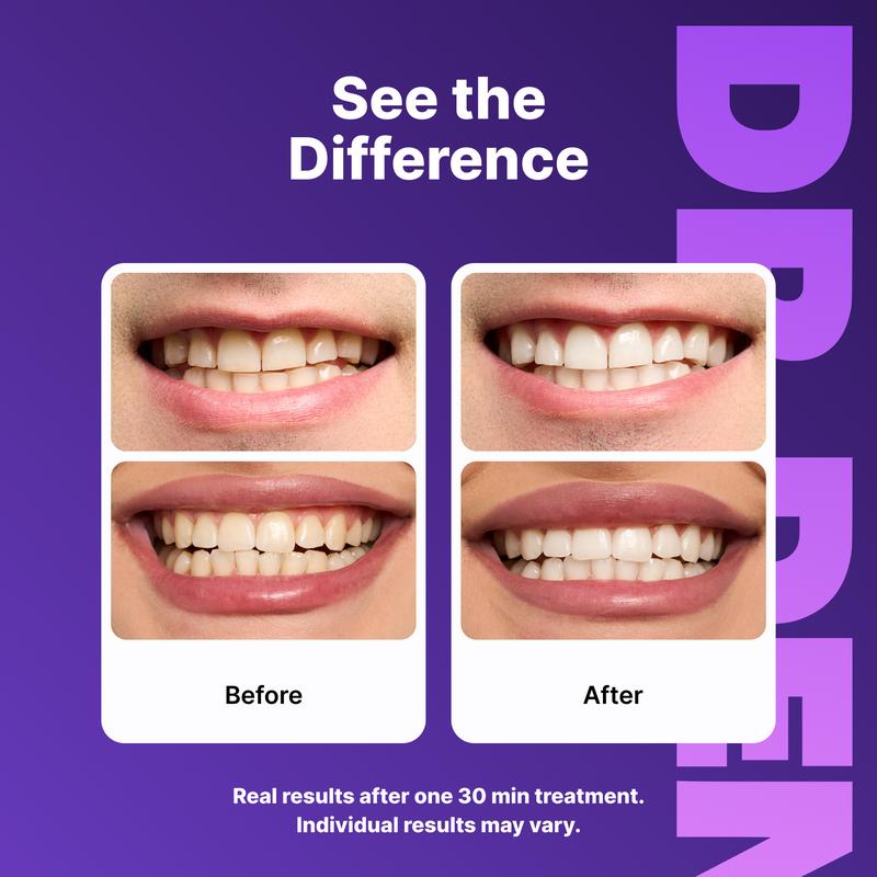 Purple Teeth Whitening Strips™ – Remove Stains & Reveal a Brighter Smile