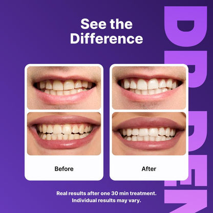 Purple Teeth Whitening Strips™ – Remove Stains & Reveal a Brighter Smile