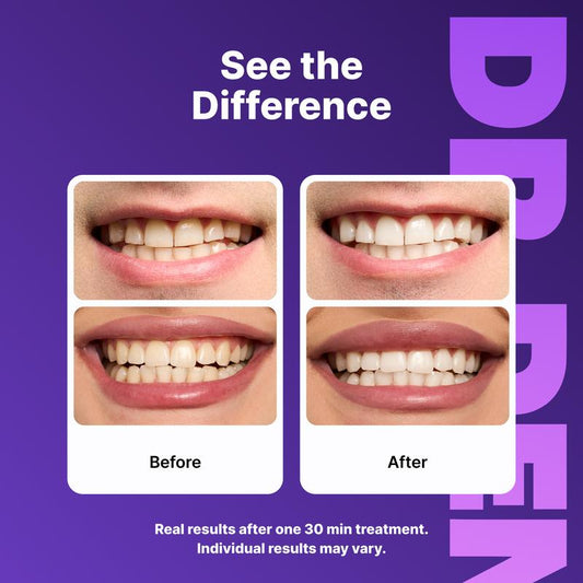 Purple Teeth Whitening Strips™ – Remove Stains & Reveal a Brighter Smile